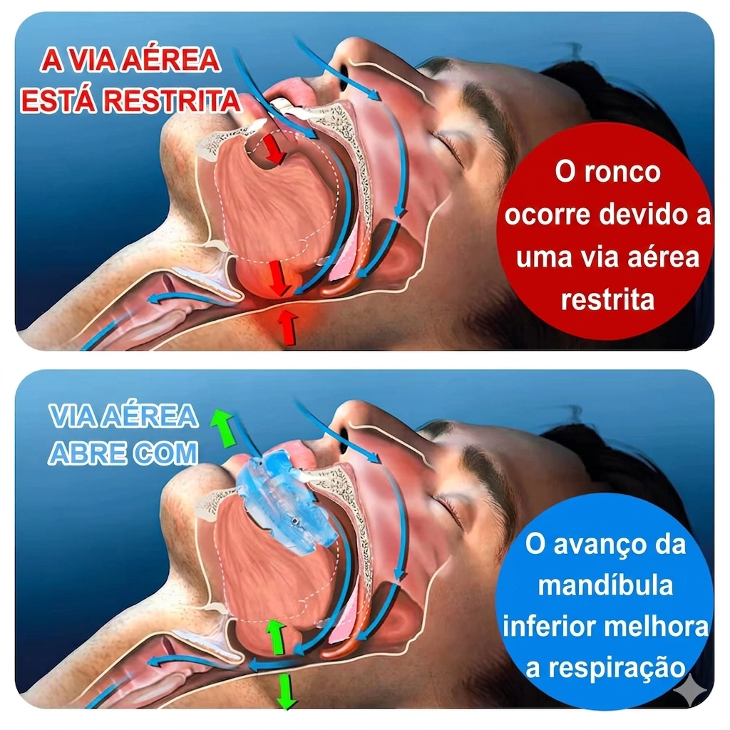 Protetor Bucal AntiRonco SleepFit™ – COMPRE 1 LEVE 2